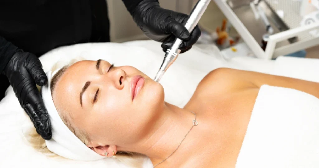 A women receiving Scarlet srf Microneedling Kirkland, Washington