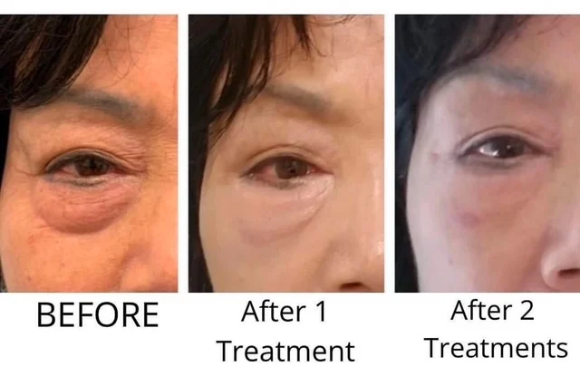 Agnes Eyes lake washington medical aesthetics kirkland WA