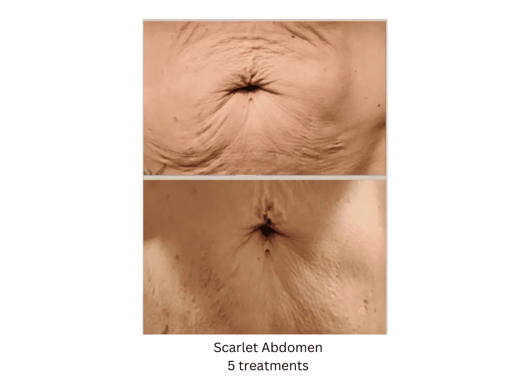 Scarlet SRF Abdomen lake washington medical aesthetics kirkland WA