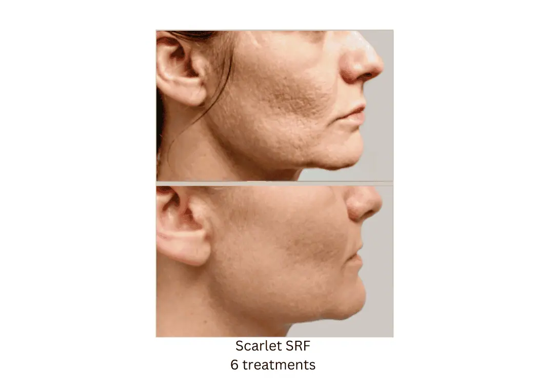 Scarlet SRF Face 6 treatments lake washington medical aesthetics kirkland WA