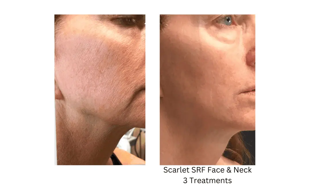 Scarlet SRF Face Neck lake washington medical aesthetics kirkland WA
