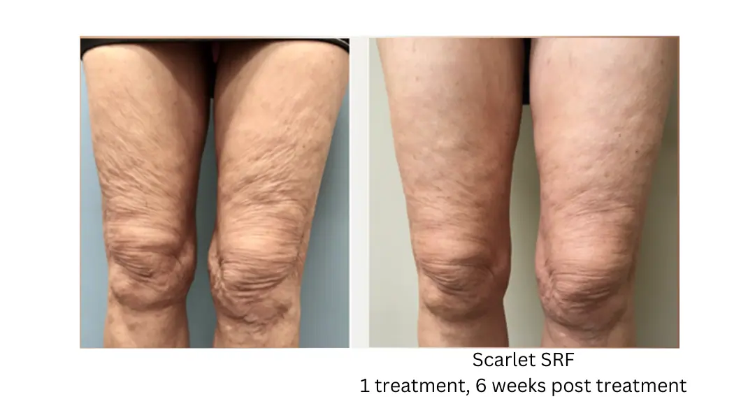 Scarlet SRF Thighs lake washington medical aesthetics kirkland WA