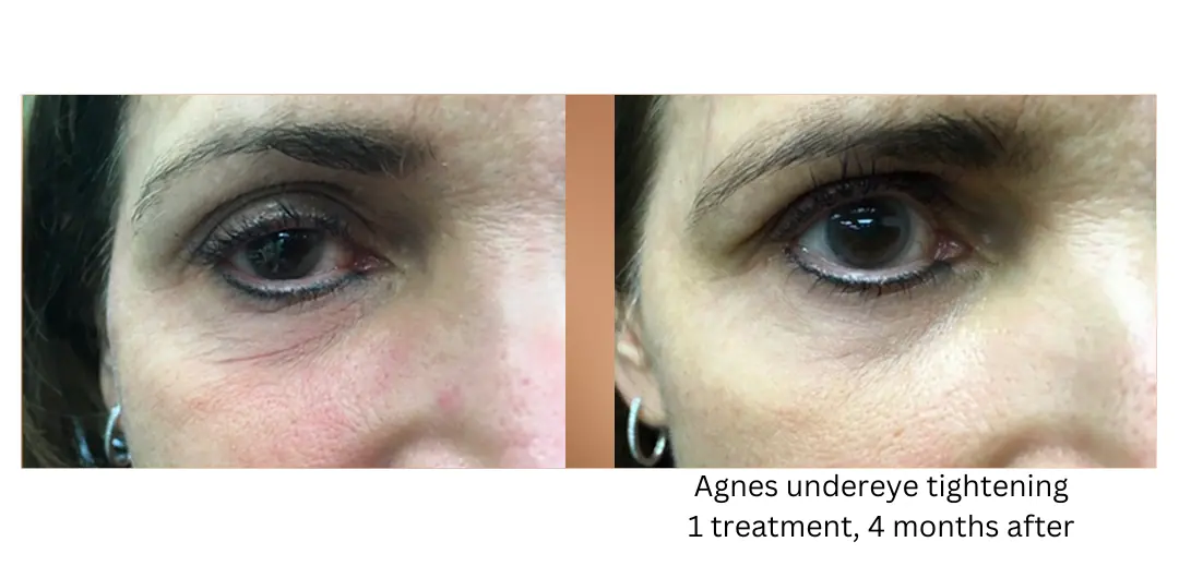 a close up of a woman's eyes lake washington medical aesthetics kirkland WA
