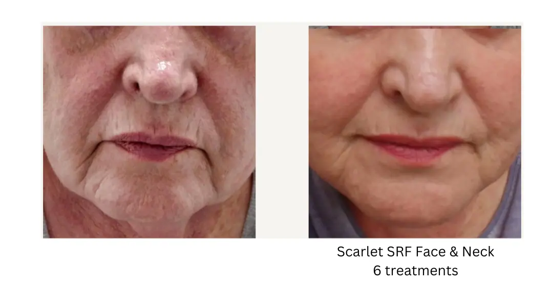 a close up of a woman's face lake washington medical aesthetics kirkland WA