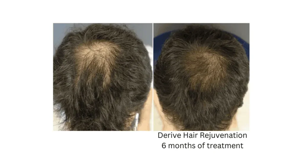 a collage of hair loss treatment lake washington medical aesthetics kirkland WA