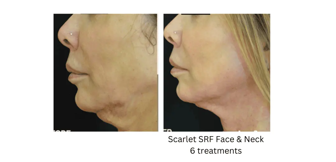 a side view of a woman's lake washington medical aesthetics kirkland WA