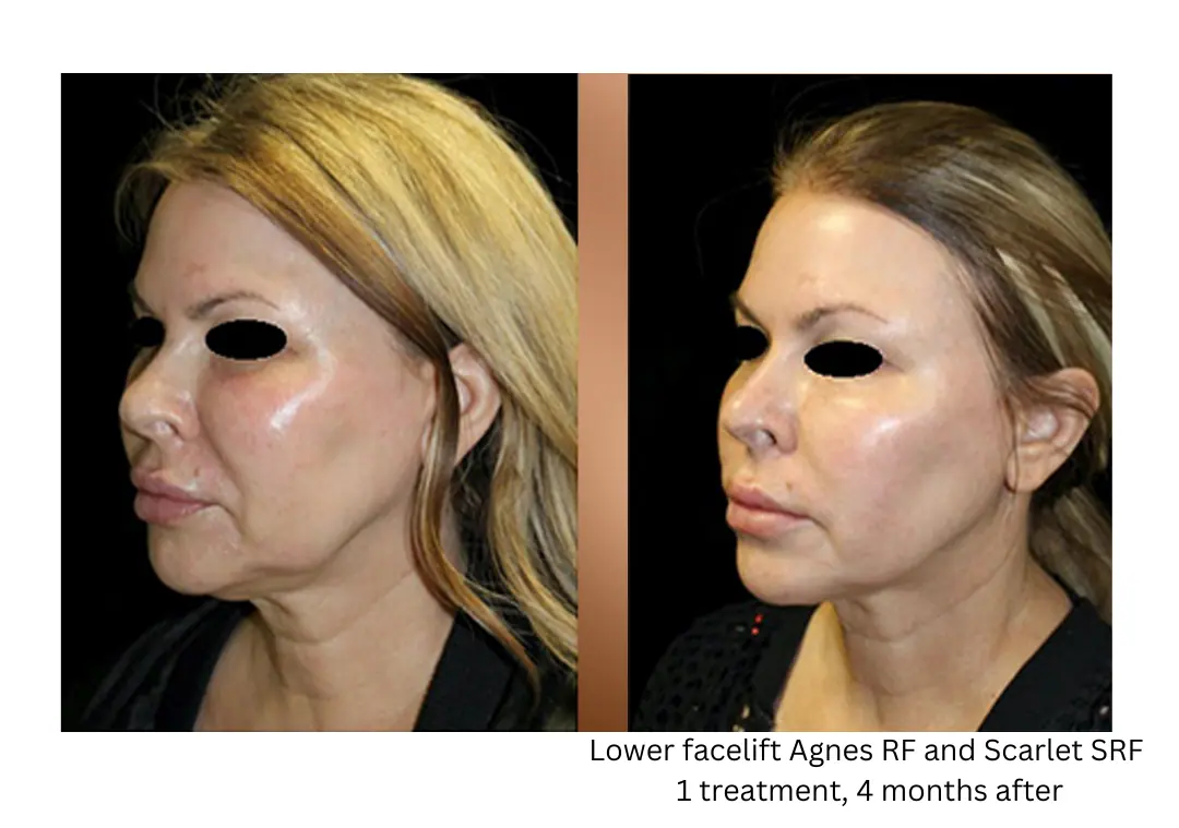 a woman with a mask on her face lake washington medical aesthetics kirkland WA
