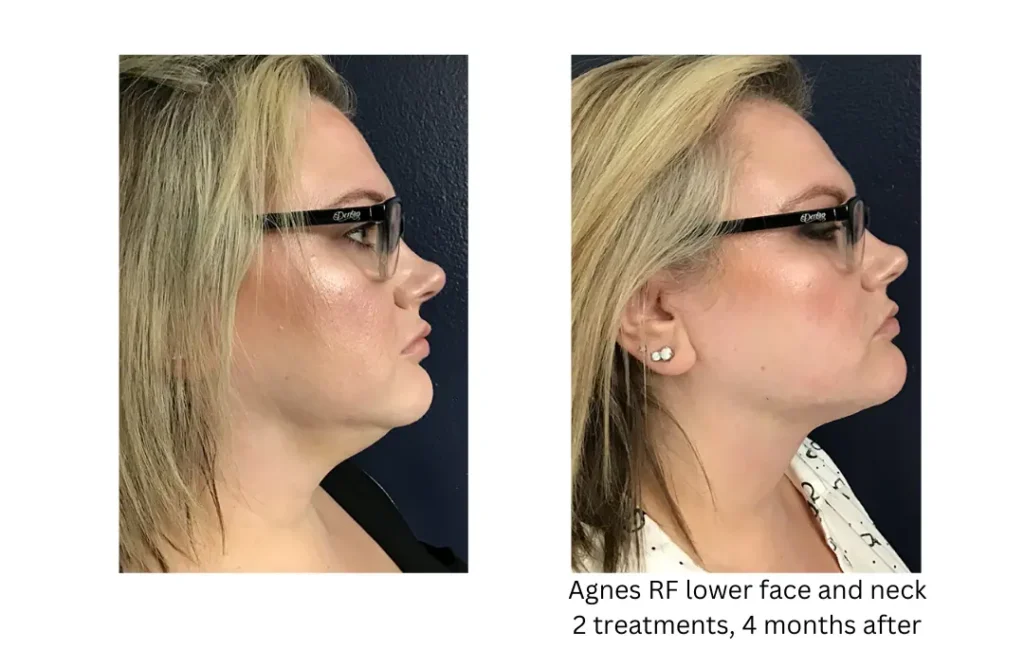 a woman with glasses and a side view of her face lake washington medical aesthetics kirkland WA