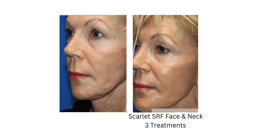 a woman's face before and after lake washington medical aesthetics kirkland WA