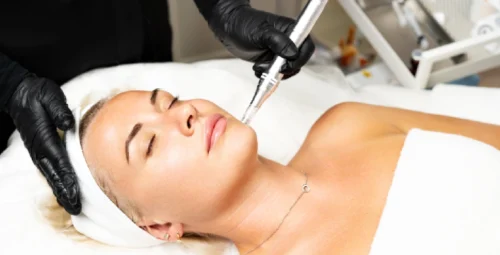 A women receiving Scarlet srf Microneedling Kirkland, Washington