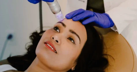 RF Microneedling in Kirkland WA